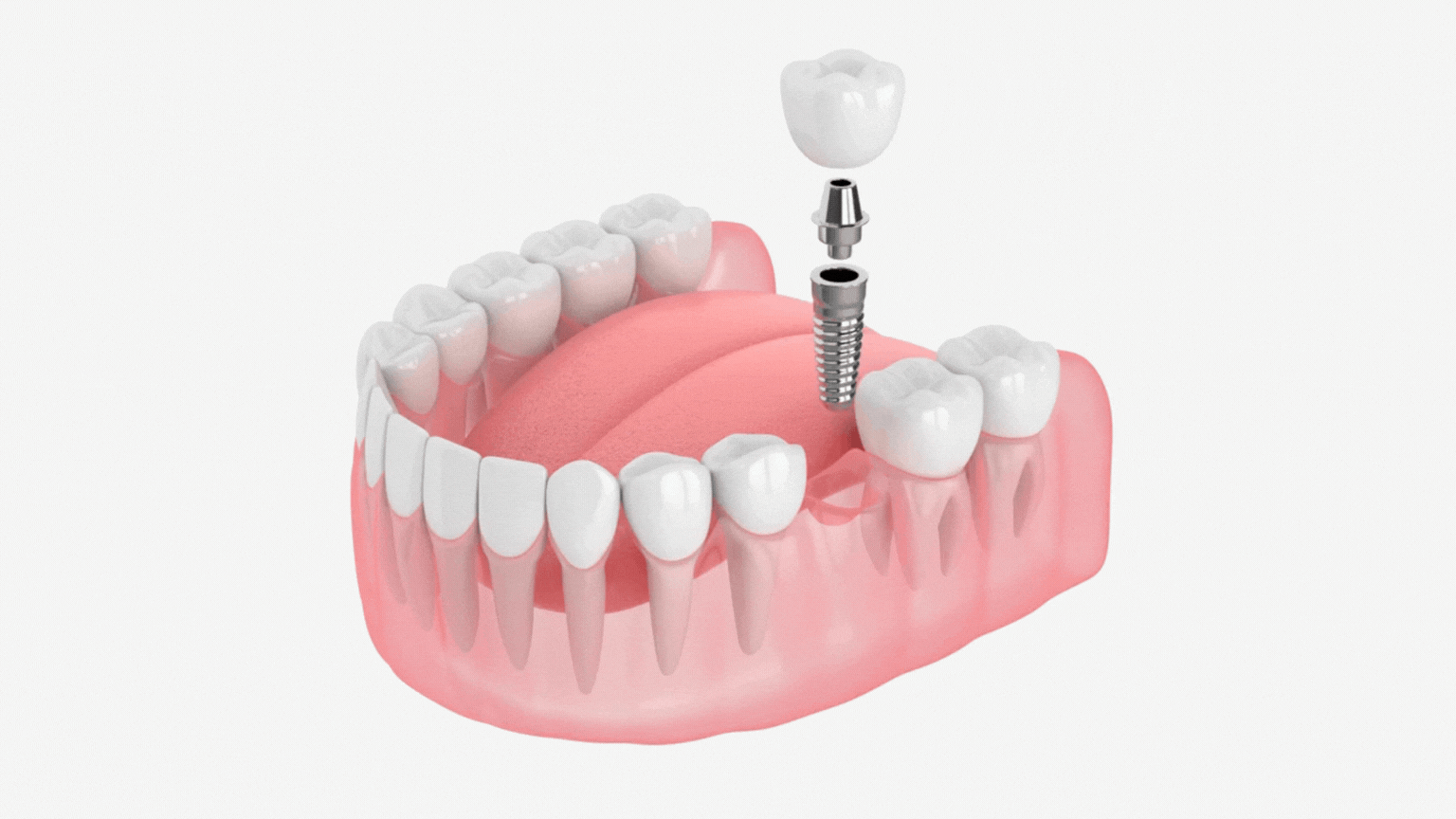 Dental Implant Video illustration