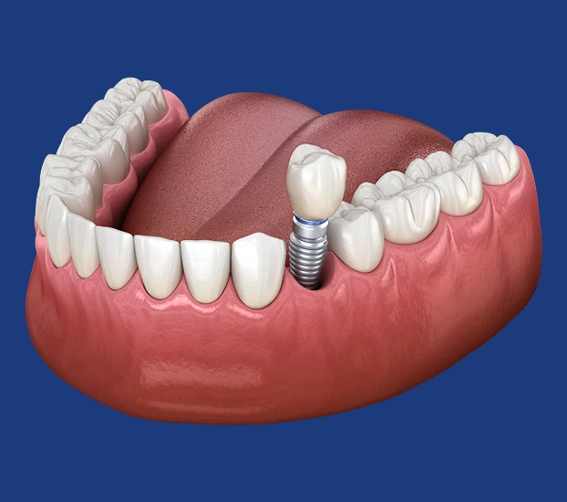 illustration of dental implants